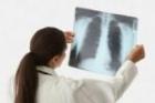 На риск возникновения рака легких влияют хронический бронхит, эмфизема легких и пневмония