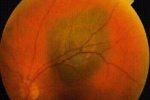 Переворот в медицине: гены подсказали причину развития рака глаза