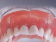 Найдена альтернатива съемному протезированию зубов