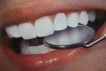 Как спасти зубы от кариеса