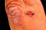 Заболевание кожи - предвестник серьезных болезней органов