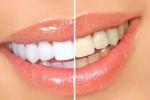 Что такое фторлак, и зачем им покрывать зубы?