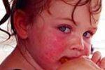 Детская пищевая аллергия